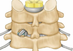 4 Reasons Endoscopic Cervical Laminotomy Delivers Superior Results